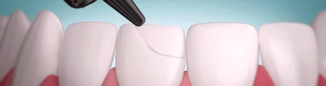 Восстановление зубов пломбами и реставрация