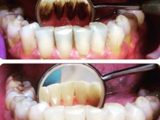 удаление поддесневых и наддесневых зубных отложений ультразвуковым аппаратом 