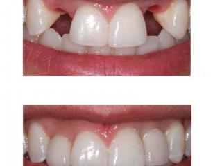 Эстетическое восстановление фронтальной группы зубов
