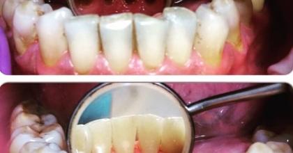 удаление поддесневых и наддесневых зубных отложений ультразвуковым аппаратом 