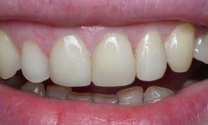 Зубы после реставрации фотополимерами