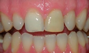 Потемнение эмали переднего зуба после наращивания