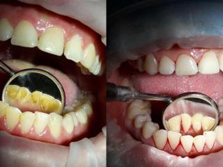 Удаление твердого пигментированного зубного налета с помощью ультразвука и аппарата AirFlow
