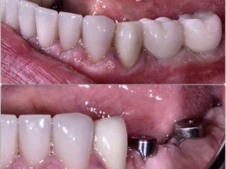 Восстановление жевательной группы зубов на нижней челюсти