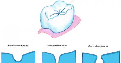 герметизация фиссур