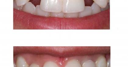 Эстетическое восстановление фронтальной группы зубов