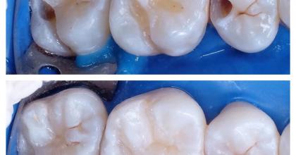 Лечение кариеса и эстетическое востановление жевательных зубов